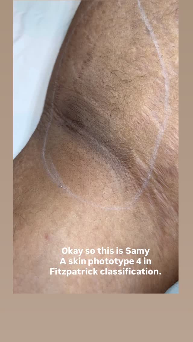 ✨ Today we welcomed a 20-year-old patient who came with his mom for underarm laser hair removal. For him, this treatment is a real gift for the future, helping him gain more independence in his daily hygiene.

After only 2 sessions with Triton (InMode), his results are already amazing — just a few hairs left! 🙌

What I love about this technology is its safety and efficiency on different skin types, including darker phototypes (IV, V, VI). This allows us to treat patients from Indian, Asian, and many other backgrounds with beautiful results.#sparueontariomontreal #bestfacialmontreal #lasermontreal #esthéticiennemontréal #laserdarkskinmontreal #kbpuremontreal #vagheggimontreal #bodyspamontreal