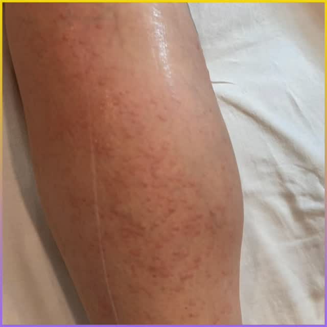 ✨ “Let’s talk about one single laser pass using the Triton by InMode. This handpiece combines two wavelengths — 755 and 810 nanometers — working together in a single shot.

The 755 nanometer wavelength, known as Alexandrite, targets finer and lighter hairs closer to the surface of the skin. The 810 nanometer wavelength, or Diode, penetrates deeper, reaching the hair follicles that are thicker and darker.

By blending these two energies at once, Triton offers a more complete, safe, and efficient treatment for different hair and skin types. With one pass, we can treat multiple hair depths and densities, giving smoother, longer-lasting results with minimal discomfort.” ✨

#sparueontariomontreal #bestfacialmontreal #lasermontreal #bodyspamontreal #laserhairremovalmontreal #lasertritonmontreal #dermoesthetician