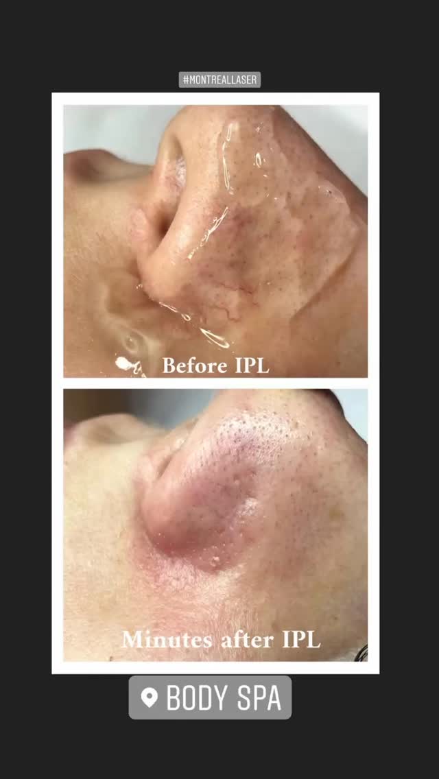 The best time for IPL is here! 

#iplmontreal #iplbrossard #ipllongueuil #iplsthubert #iplrivesud