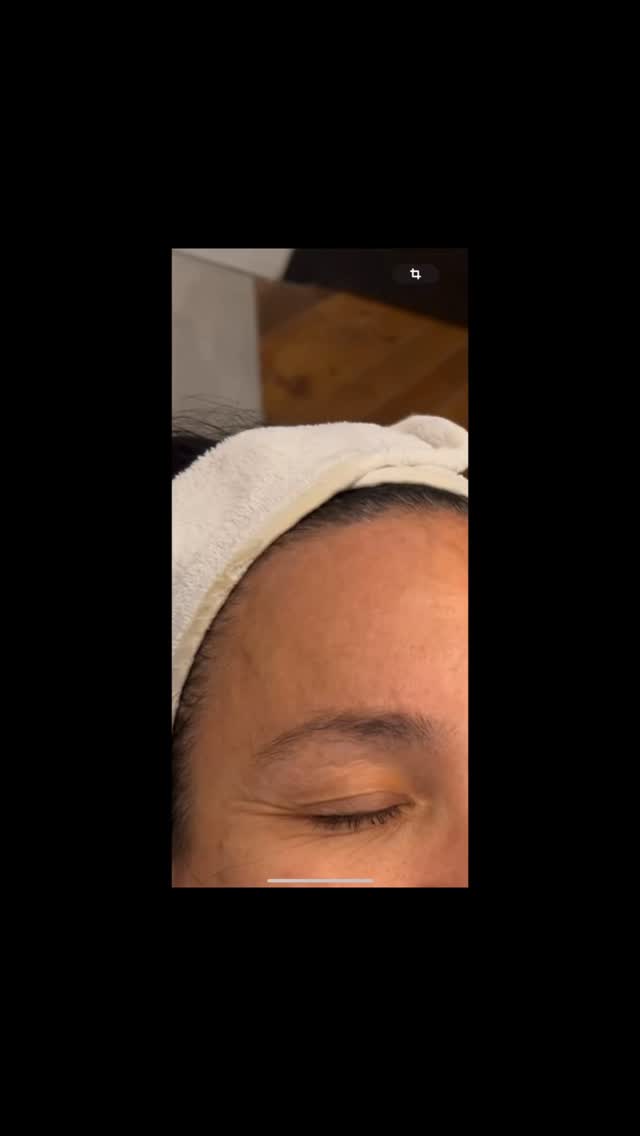 Today, I’m presenting an IPL treatment performed on a patient with superficial pigment spots such as freckles, which means surface hyperpigmentation, as well as deeper pigment lesions like melasma.
I zoomed my videos on the forehead area.

On the next slide, you can see right after the treatment — the gel is still on the skin, and the protective goggles are covering the eyes.
On the third slide, the gel has been removed, and the skin is freshly treated, just a few minutes after the procedure.

For the parameters, I worked with the Triton #lumecca platform, using a 580-nanometer filter.
I performed two passes:
– The first one at 11 joules, with a shorter wavelength, to target the more superficial pigmentation.
– The second one at 14 joules, with a longer pulse duration, to address the vascular component.

Since the patient has a skin phototype III, leaning slightly toward IV, I adjusted the settings to protect the skin while maintaining optimal efficacy.

When I perform a full-face treatment, I always go from the forehead down to mid-neck level.
Finally, on the before-and-after photos, you can clearly see that the pigment spots have come closer to the surface, which indicates a successful treatment outcome.

And to finish, here’s a picture of me :) performing the treatment, holding the handpiece with my protective goggles on.
The session was a success, and we invite clients to come and experience this IPL treatment for themselves!

#sparueontariomontreal #iplmontreal #iplsouthshore #iplbrossard #skinrejuvenatingtreatmentmtl