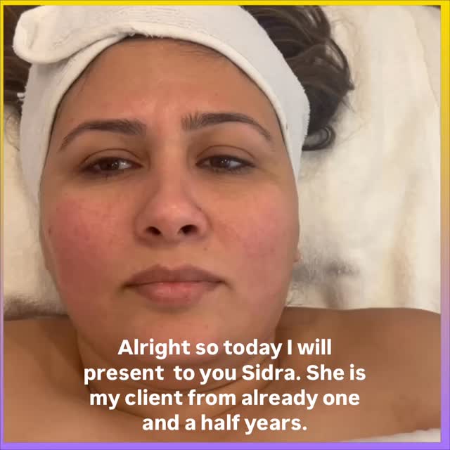 ✨ Aujourd’hui, je vous présente ma cliente et notre belle réussite ! ✨

Elle est venue me voir avec une rosacée active, une peau sensible, réactive, et qui demandait beaucoup de douceur et de constance.
Nous avons réalisé plusieurs soins adaptés, étape par étape, pour apaiser l’inflammation, renforcer la barrière cutanée et stabiliser progressivement sa peau.

🌿 Aujourd’hui, sa peau est calme, équilibrée et beaucoup plus uniforme.
C’est une grande fierté pour nous deux !

Cependant, il ne faut jamais oublier que les conditions auto-immunes comme la rosacée demandent une surveillance et un entretien régulier. On avance ensemble, toujours à l’écoute de sa peau.

💡 Pour finaliser ce protocole, nous allons effectuer un dernier IPL très léger, juste pour uniformiser et sublimer encore davantage son teint.

🌸 Bravo ma belle pour ta constance et ta confiance !
On célèbre aujourd’hui un vrai progrès — et une peau qui respire enfin la sérénité. 🤍