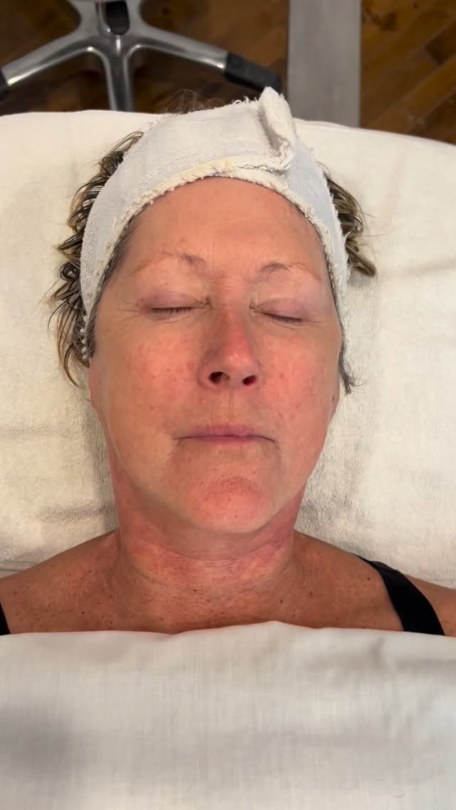 My client is comfortably on the table receiving an IPL treatment. Before starting, I carefully shave any peach fuzz. If the hair is light, I remove it to prevent it from acting like a “screen,” allowing the light to penetrate evenly and ensuring optimal skin results. If the hair is darker, shaving also allows the IPL to effectively target and reduce unwanted hair at the same time.

This way, during the same session, we can improve skin tone, reduce dark spots and visible vessels, and address fine dark hairs — offering multiple benefits in one treatment.🤍

Ma cliente est confortablement installée sur la table pour son traitement IPL. Avant de commencer, je rase délicatement le duvet.

Si le poil est clair, je l’enlève afin qu’il ne fasse pas écran à la lumière et pour permettre une pénétration optimale, garantissant ainsi de meilleurs résultats sur la peau.

Si le poil est plus foncé, le rasage permet également à l’IPL de cibler et de réduire le poil efficacement en même temps.

Ainsi, au cours de la même séance, nous pouvons améliorer le teint, atténuer les taches pigmentaires et les petits vaisseaux visibles, tout en traitant les poils foncés et fins — offrant plusieurs bénéfices en un seul soin. 🤍