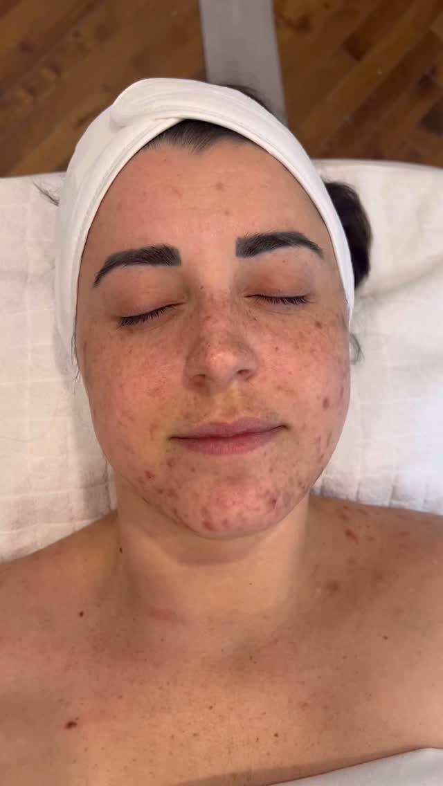 Dans cette vidéo, je vous présente l’évolution d’une cliente très engagée dans sa cure de soins personnalisés.

Nous sommes encore à une étape relativement récente du processus, mais plusieurs interventions ont déjà été réalisées afin de diminuer l’inflammation cutanée et de préparer la peau à des traitements plus ciblés. Parmi ces soins, nous avons notamment effectué plusieurs peelings chimiques, permettant d’améliorer progressivement la qualité et la texture de la peau.

À ce stade de l’analyse, on observe encore différentes problématiques cutanées :
• Hyperpigmentation post-inflammatoire liée à l’acné
• Marques rouges récentes correspondant à des cicatrices post-inflammatoires
• Taches brunes résiduelles
• Une pigmentation plus diffuse pouvant évoquer un mélasma ou des éphélides (taches de rousseur)

Nous arrivons maintenant à un point stratégique dans le protocole de traitement :
continuer avec les mêmes approches progressives ou passer à une technologie plus avancée, comme la lumière pulsée intense (IPL), afin de cibler plus efficacement les différentes formes d’hyperpigmentation.

Chaque peau évolue différemment, et c’est précisément pour cela que l’analyse et l’ajustement des traitements font partie intégrante d’une prise en charge personnalisée.
