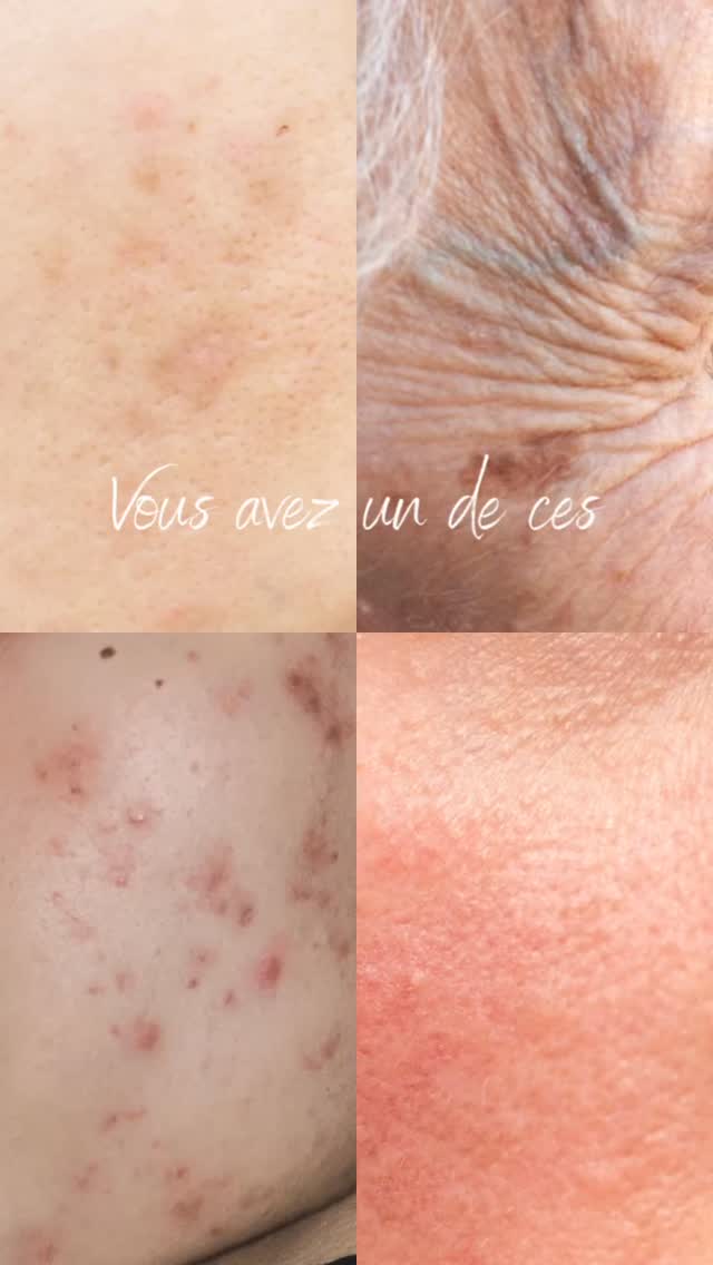 ✨ Acné, rides, rosacée, taches pigmentaires…
Chaque peau a ses défis. Mais surtout : chaque peau a des besoins différents.

Le plus grand erreur ?
Traiter tous les problèmes de peau de la même façon.

💡 C’est pour ça qu’un diagnostic est essentiel.

Comprendre ta peau permet de créer :
✔️ un protocole adapté
✔️ des soins ciblés
✔️ une routine efficace à la maison

Parce qu’une belle peau ne vient pas d’un produit miracle…
mais d’une stratégie pensée pour TOI ✨

Avec plus de 25 ans d’expérience, je t’accompagne comme une vraie coach de peau :
on analyse, on comprend, et on traite avec précision 🤍

📍 Body Spa Montréal
💌 Écris-nous en DM pour commencer ton diagnostic peau

#acnemontreal #rosacee #antiage tachespigmentaires #skincaremtl estheticiennemontreal soinvisage #coachdepeau